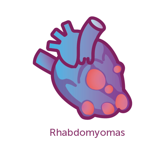 Heart Tumor Rhabdomyomas